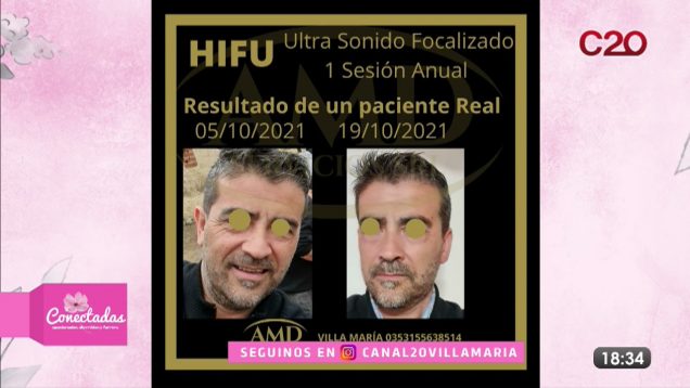 Conectadas – Natalia Olivero – Lifting son cirugía