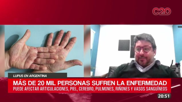 C20 Noticias | Lupus en Argentina – Alejandro Brigante