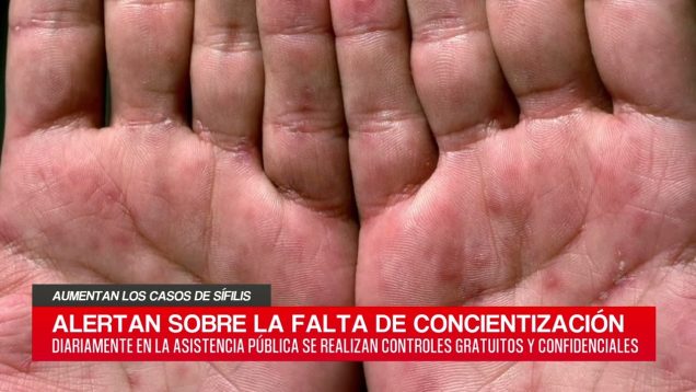 C20 Noticias | Aumento de casos de sífilis – Julián López